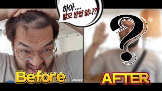 27살 젊은 나이에 탈모가 찾아왔어요.....(feat…